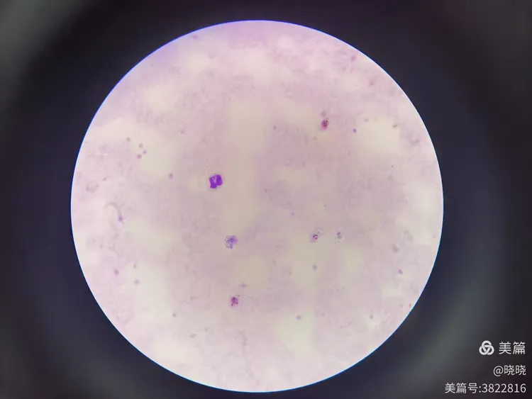 三种疟原虫厚膜染色法对比